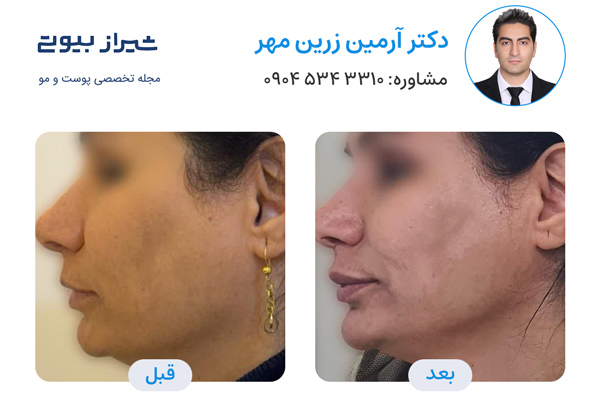 اندولیفت در شیراز - دکتر آرمین زرین مهر