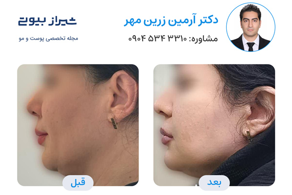 اندولیفت در شیراز - دکتر آرمین زرین مهر