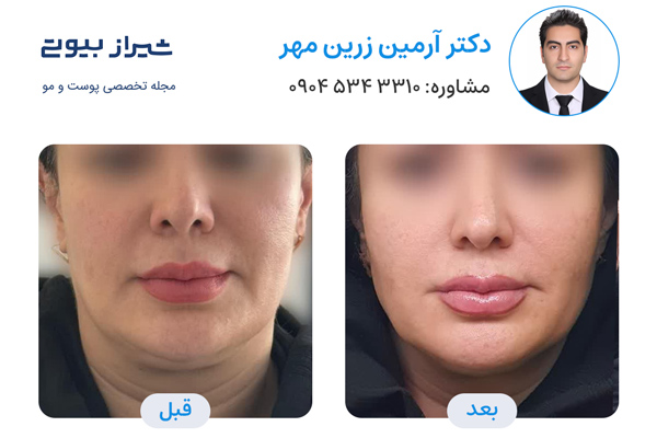 اندولیفت در شیراز - دکتر آرمین زرین مهر