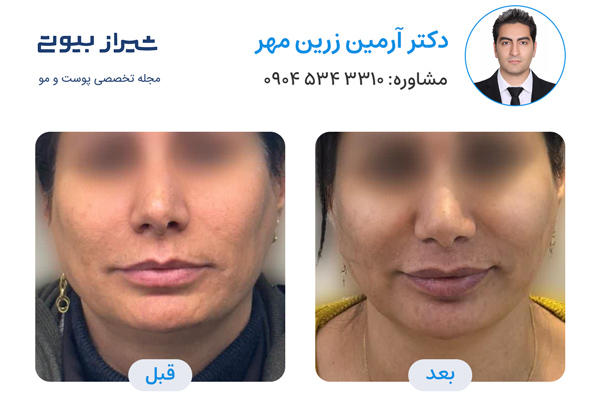 اندولیفت در شیراز - دکتر آرمین زرین مهر