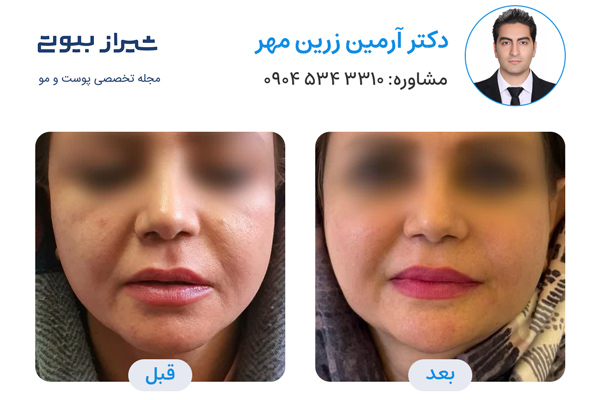 اندولیفت در شیراز - دکتر آرمین زرین مهر
