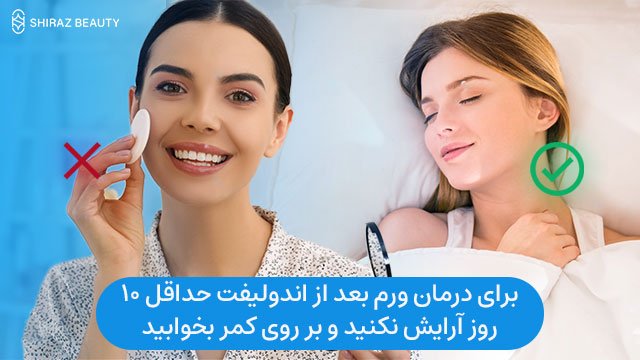 برای درمان ورم بعد از اندولیفت حداقل 10 روز آرایش نکنید و بر روی کمر بخوابید