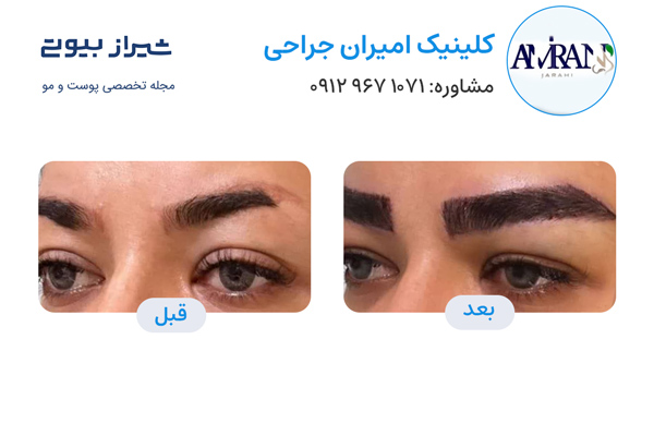کاشت ابرو در شیراز - کلینیک امیران جراحی