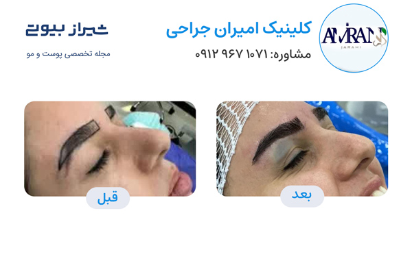 کاشت ابرو در شیراز - کلینیک امیران جراحی