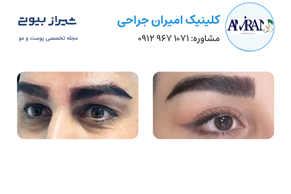 کاشت ابرو در شیراز - کلینیک امیران جراحی