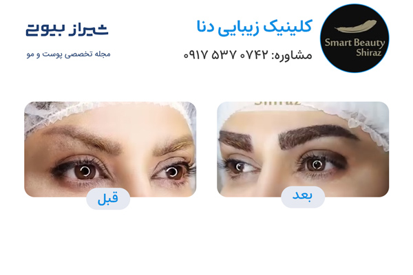 کاشت ابرو در شیراز - کلینیک دنا
