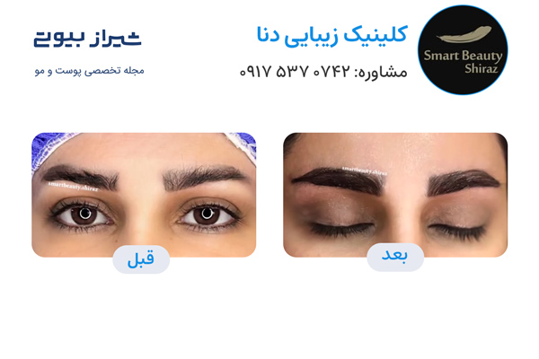کاشت ابرو در شیراز - کلینیک دنا