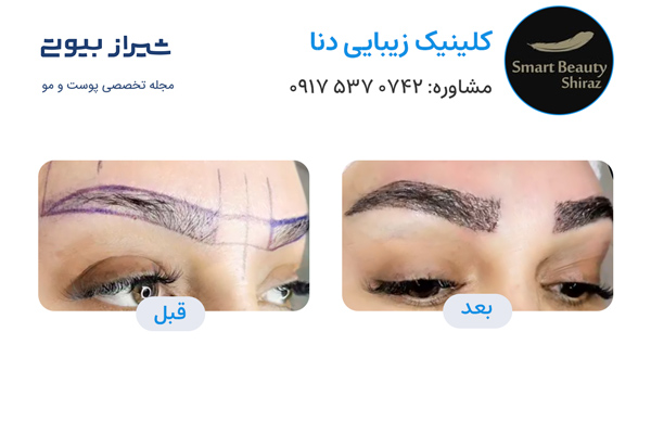 کاشت ابرو در شیراز - کلینیک دنا