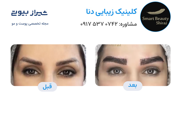 کاشت ابرو در شیراز - کلینیک دنا