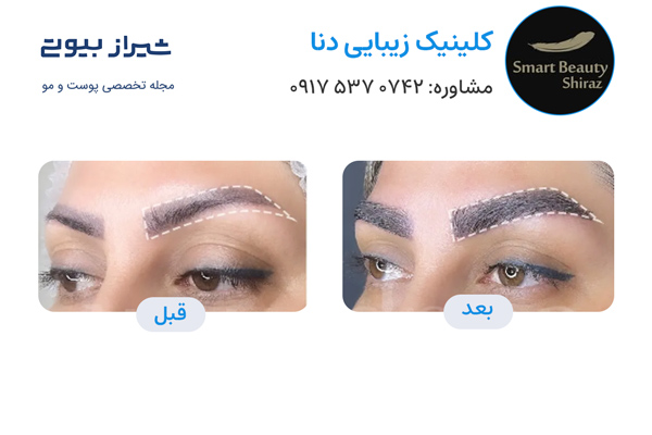 کاشت ابرو در شیراز - کلینیک دنا