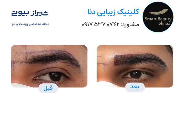 کاشت ابرو در شیراز - کلینیک دنا