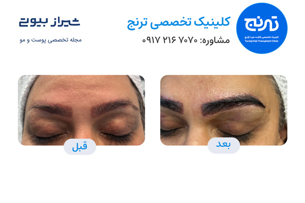 کاشت ابرو در شیراز - کلینیک ترنج