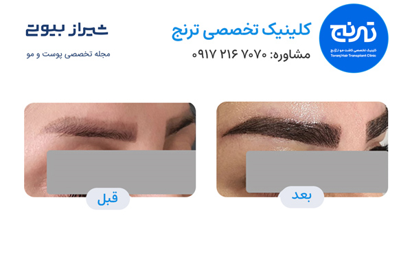 کاشت ابرو در شیراز - کلینیک ترنج