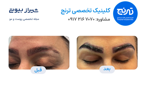 کاشت ابرو در شیراز - کلینیک ترنج