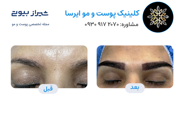 کاشت ابرو در شیراز - کلینیک ایرسا