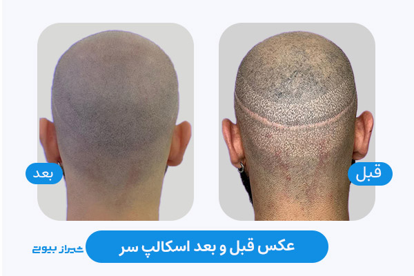 قبل و بعد میکرواسکالپ سر