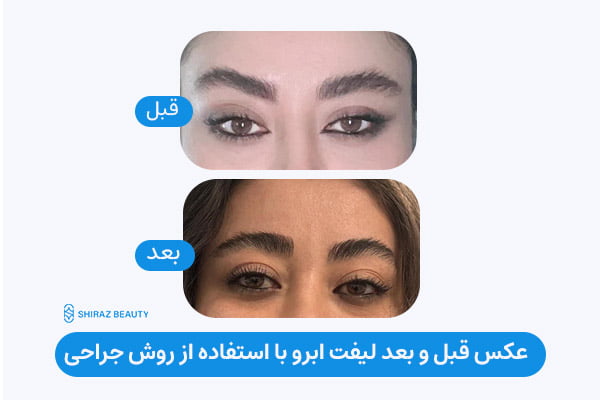 Eyebrow lift using surgery before and after