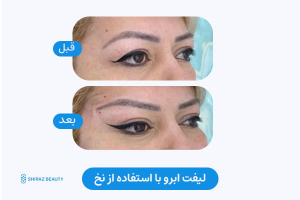 Eyebrow lift with thread before and after