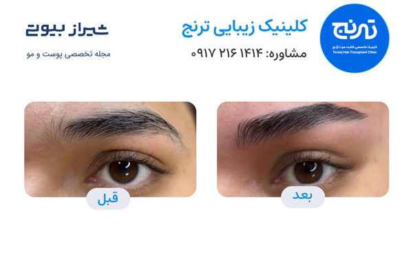 لیفت ابرو در شیراز - کلینیک ترنج