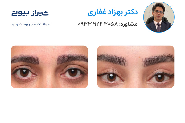 لیفت ابرو در شیراز - دکتر بهزاد غفاری