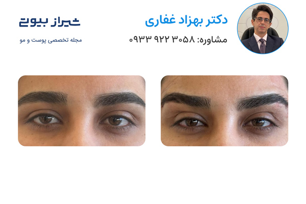 لیفت ابرو در شیراز - دکتر بهزاد غفاری