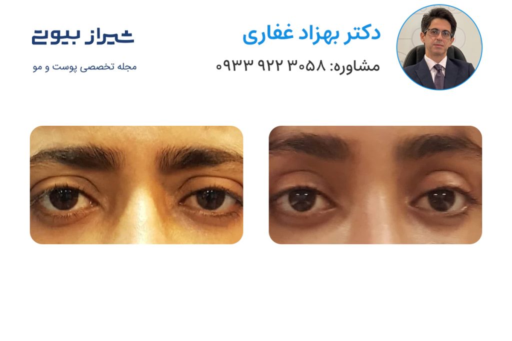 لیفت ابرو در شیراز - دکتر بهزاد غفاری
