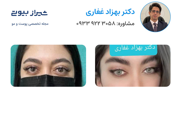 لیفت ابرو در شیراز - دکتر بهزاد غفاری