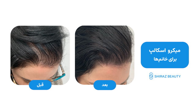 increase hair density female micro scalp before after 1