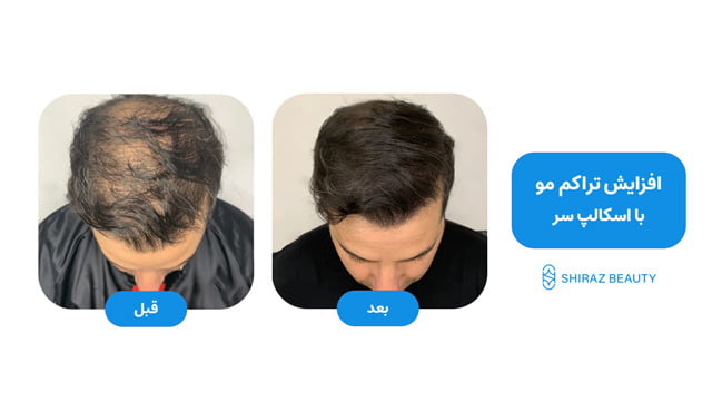 increase hair density micro scalp before after