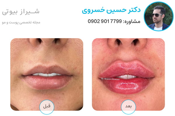 عکس قبل و بعد تزریق ژل لب در شیراز دکتر حسین خسروی