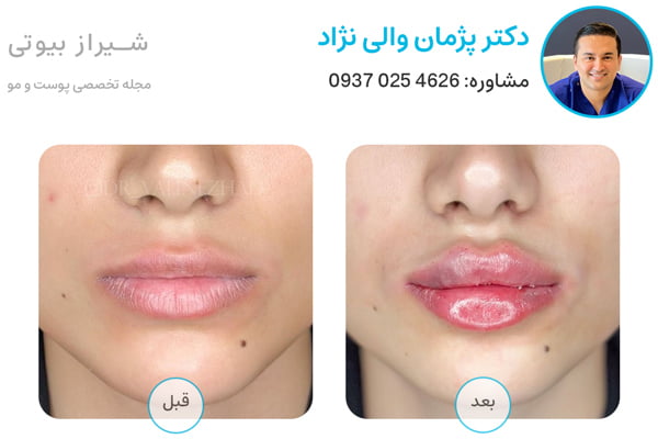 عکس قبل و بعد تزریق ژل لب در شیراز دکتر والی نژاد