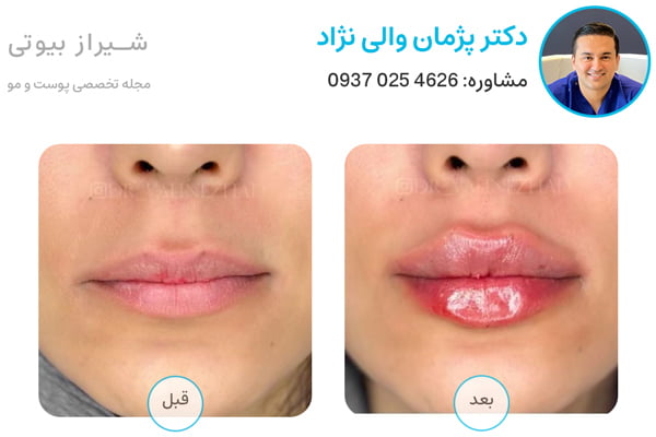 عکس قبل و بعد تزریق ژل لب در شیراز دکتر والی نژاد