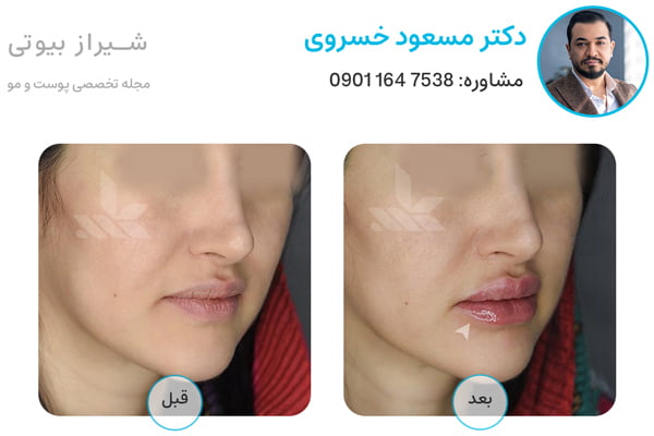 befor after template dr khosravi lipsfiller 1