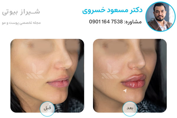 befor after template dr khosravi lipsfiller 2