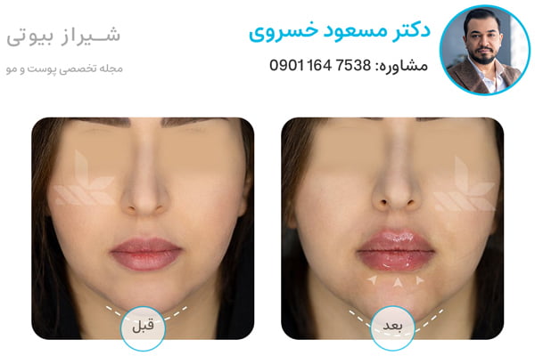 befor after template dr khosravi lipsfiller 3