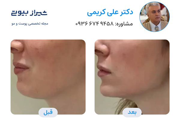 زاویه سازی صورت در شیراز - دکتر علی کریمی