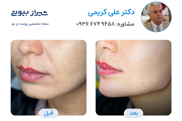 زاویه سازی صورت در شیراز - دکتر علی کریمی