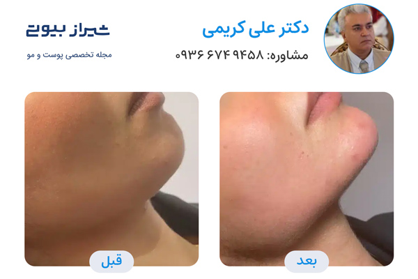 زاویه سازی صورت در شیراز - دکتر علی کریمی