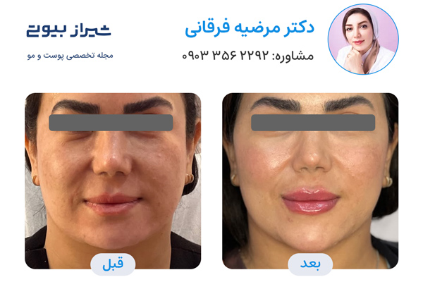 زاویه سازی صورت در شیراز - دکتر مرضیه فرقانی