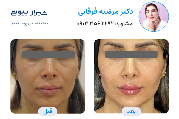 زاویه سازی صورت در شیراز - دکتر مرضیه فرقانی