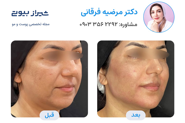 زاویه سازی صورت در شیراز - دکتر مرضیه فرقانی