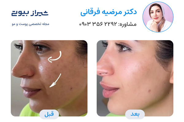 زاویه سازی صورت در شیراز - دکتر مرضیه فرقانی