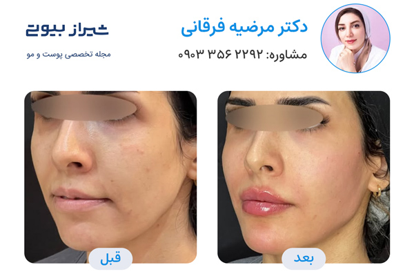 زاویه سازی صورت در شیراز - دکتر مرضیه فرقانی