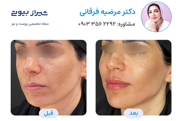 زاویه سازی صورت در شیراز - دکتر مرضیه فرقانی