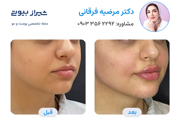 زاویه سازی صورت در شیراز - دکتر مرضیه فرقانی