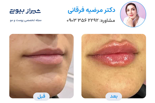 زاویه سازی صورت در شیراز - دکتر مرضیه فرقانی