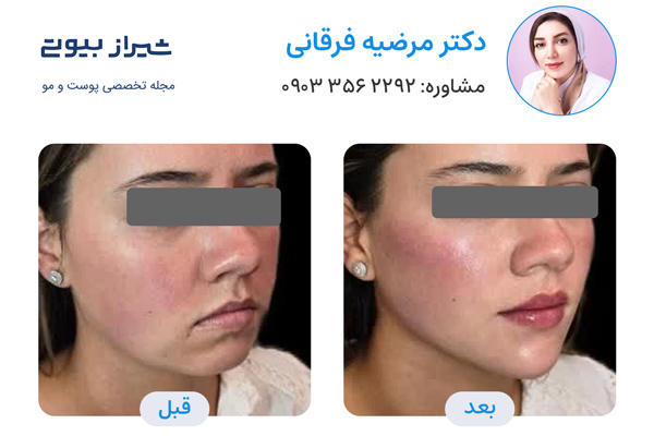 زاویه سازی صورت در شیراز - دکتر مرضیه فرقانی