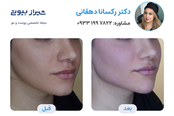 بهترین دکتر زاویه سازی صورت در شیراز - دکتر رکسانا دهقانی