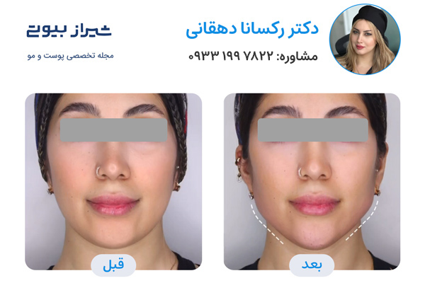 بهترین دکتر زاویه سازی صورت در شیراز - دکتر رکسانا دهقانی