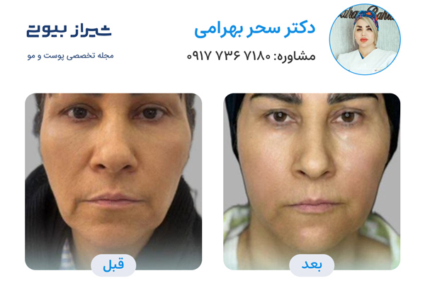 زاویه سازی صورت در شیراز - دکتر سحر بهرامی